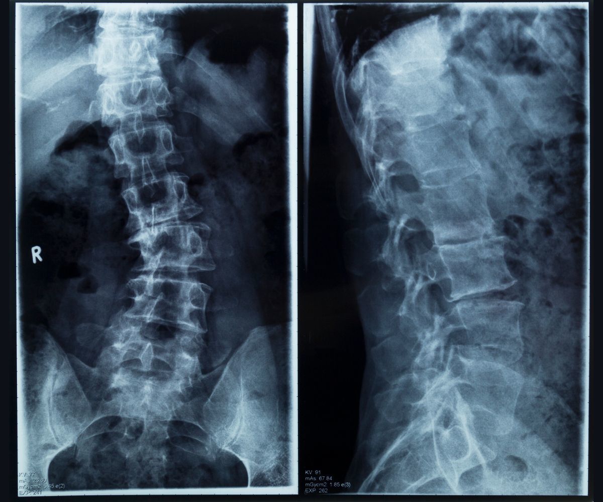 Scoliosis Xray