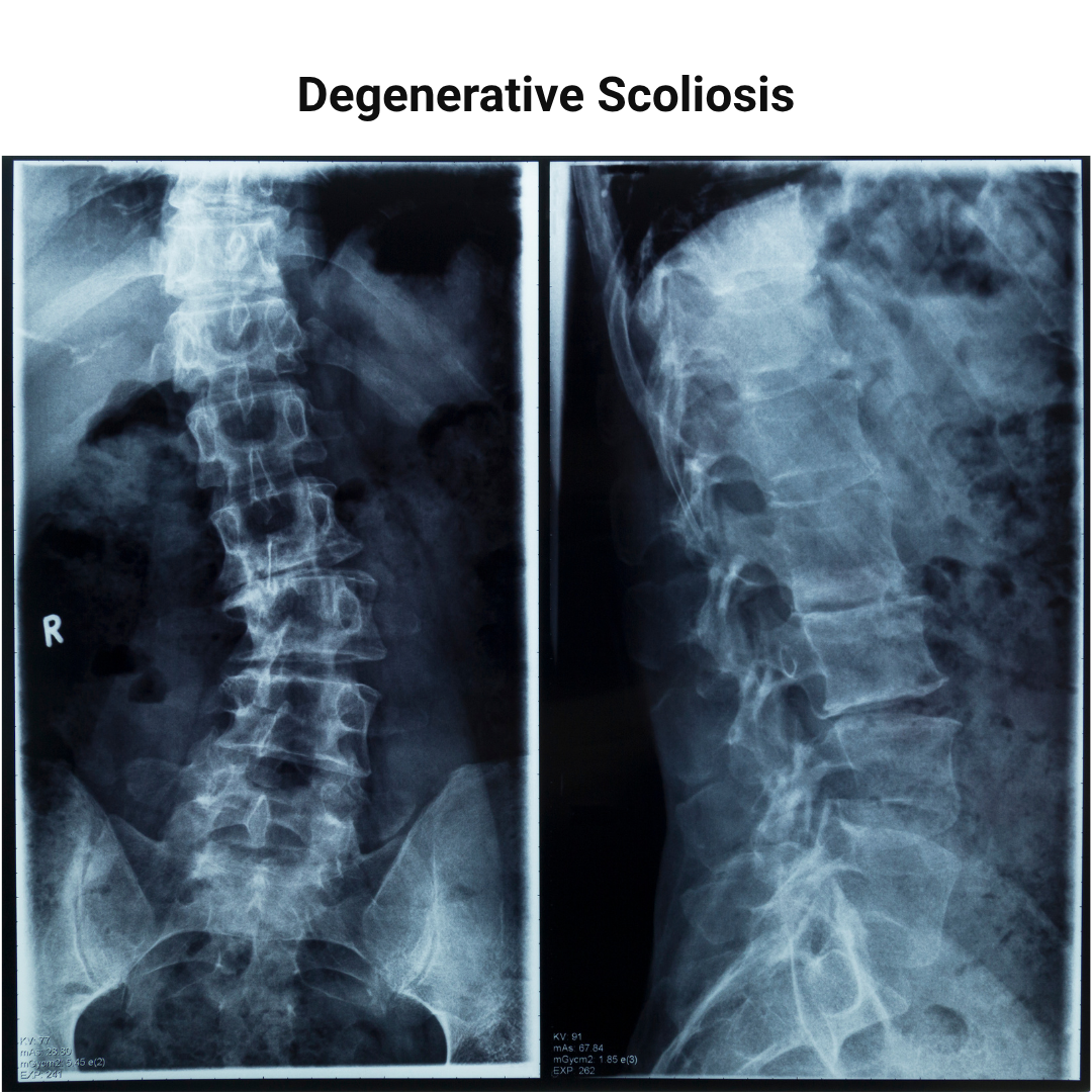 Degenerative scoliosis