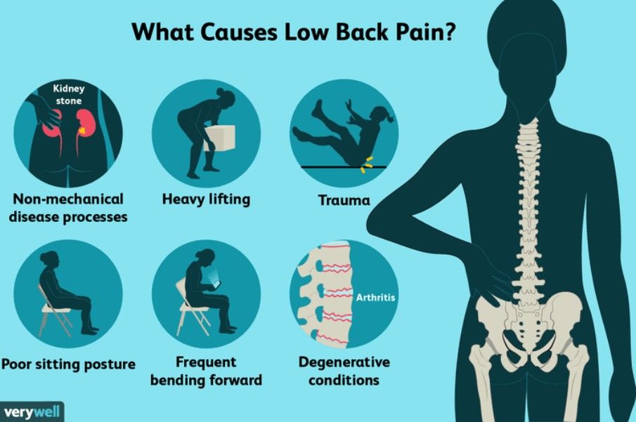 Infographic on what causes low back pain